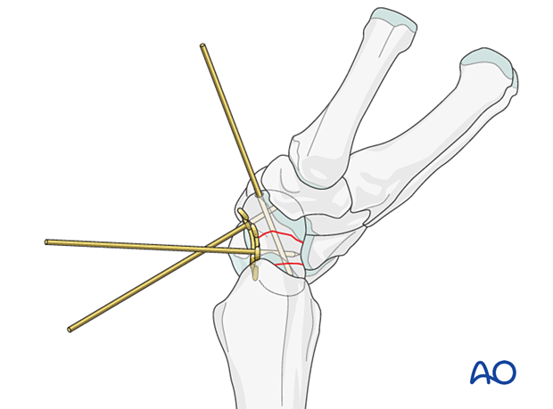 Multifragmentary scaphoid waist fracture fixed with a plate – plate application