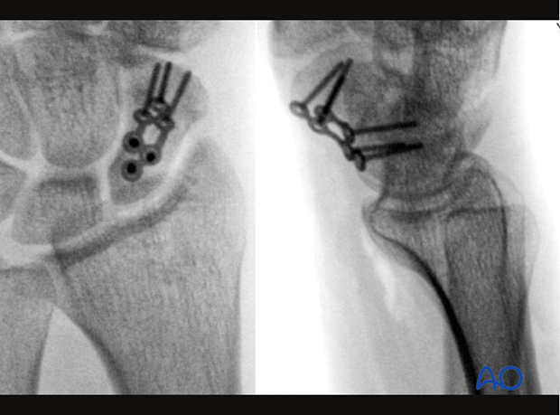 Perioperative AP and lateral views of a scaphoid waist fracture fixed with a plate