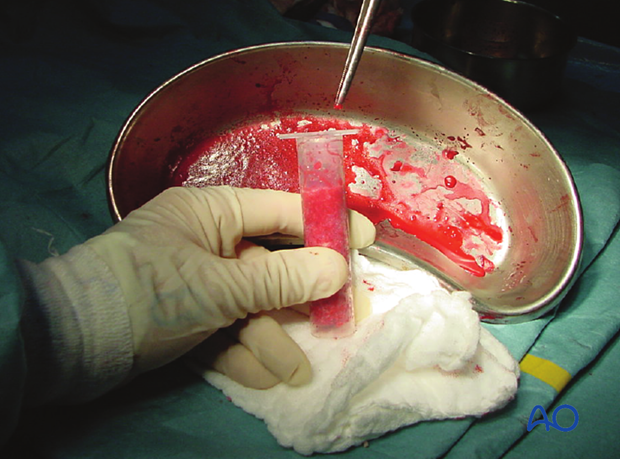 Preparing cancellous bone for impaction