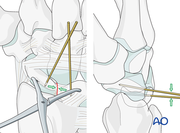 Reducing the scapholunate joint