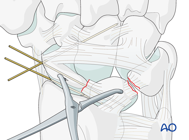 Lesser arc, lunate dislocation – transfixation of the scaphocapitate joint