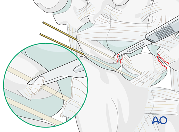 Lesser arc, lunate dislocation – assessment of dorsal and proximal ligament remnants