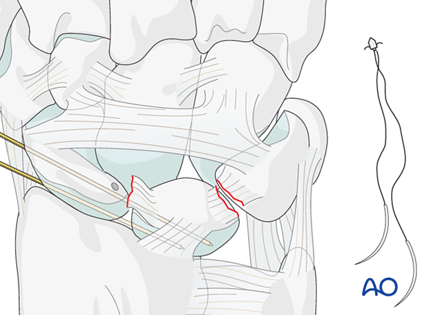 Lesser arc, lunate dislocation – insertion of a suture anchor