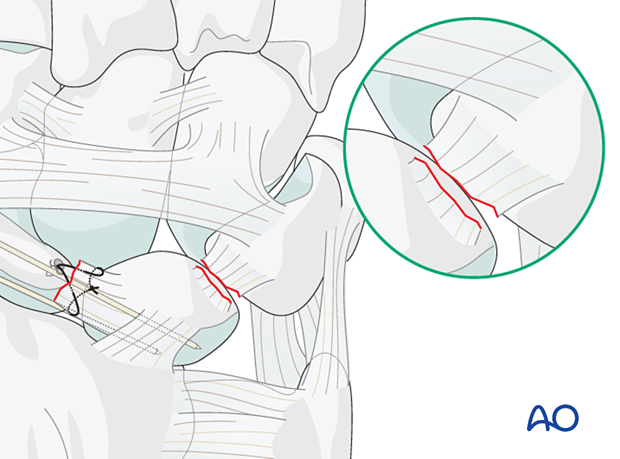 Lesser arc, lunate dislocation – lunotriquetral ligament repair