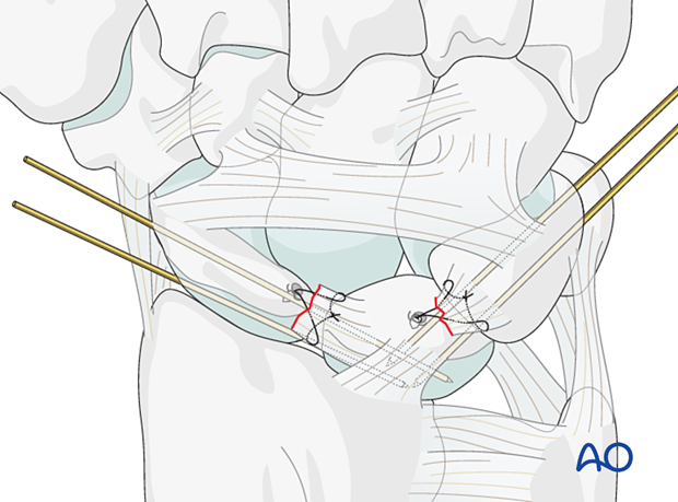 Lesser arc, lunate dislocation – lunotriquetral ligament repair