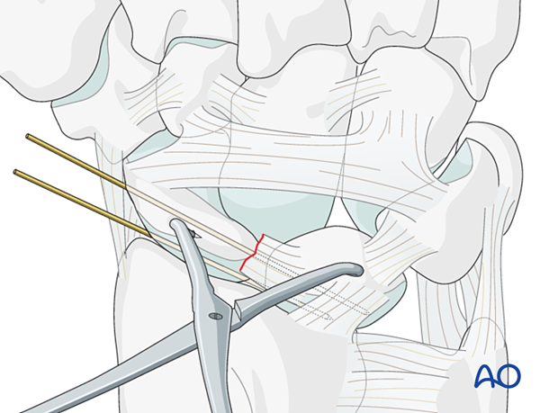 Lesser arc, scapholunate ligament injury - transfixation of the scapholunate joint