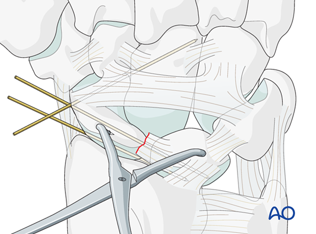 Lesser arc, scapholunate ligament injury - transfixation of the scaphocapitate joint