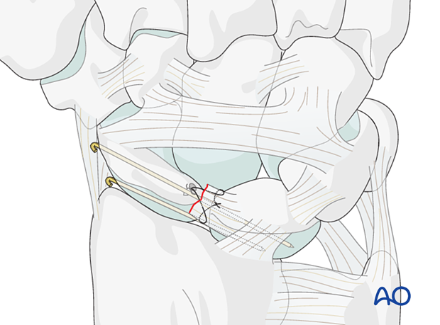 Lesser arc, scapholunate ligament injury  - open reduction and ligament repair: final construct