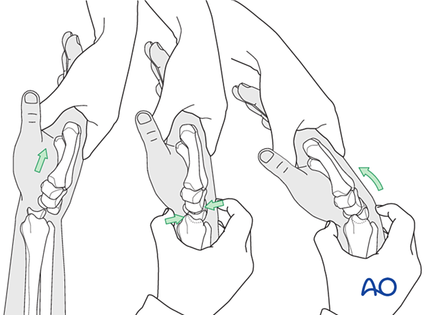 Closed reduction of the midcarpal joint