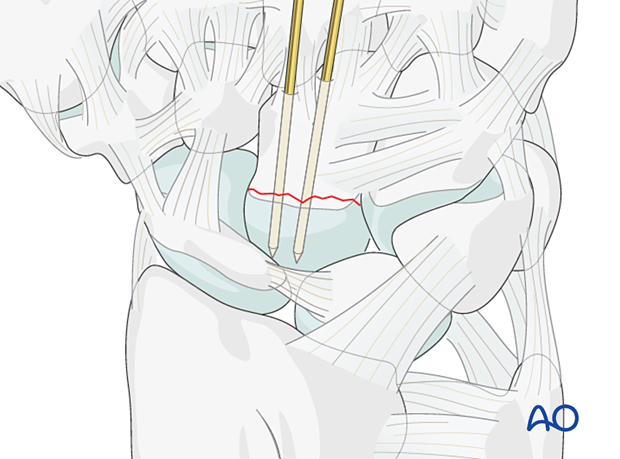 Temporary stabilization of a capitate fracture with K-wires