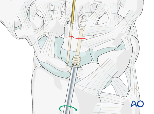 Insertion of a headless compression screw for fixation of a capitate fracture