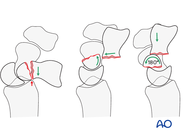 Scaphocapitate (or ‘naviculocapitate’) syndrome