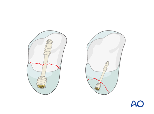 Capitate fracture fixation with headless compression screws