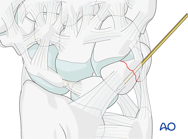 Temporary stabilization of a triquetrum fracture with a K-wire