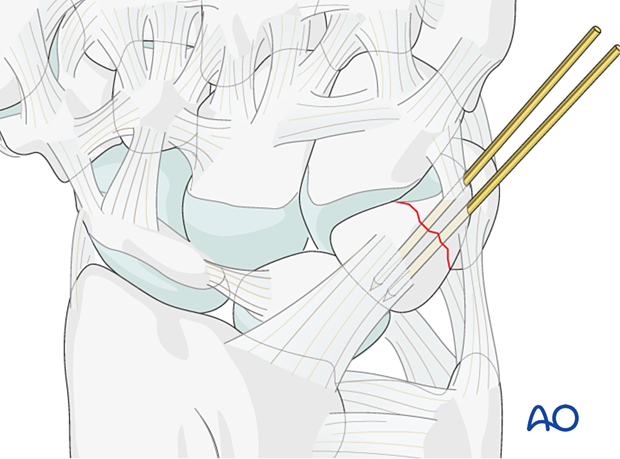 Temporary stabilization of a triquetrum fracture with K-wires