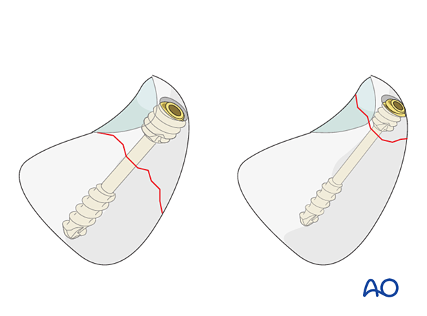 Triquetrum fracture fixation with headless compression screws