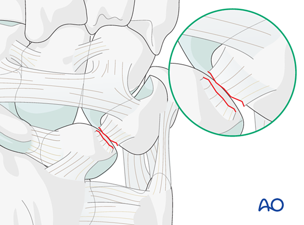 Lunotriquetral ligament torn from the lunate