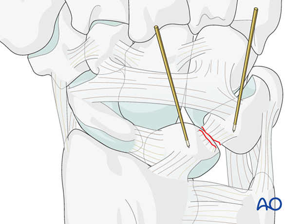 Lunotriquetral ligament rupture – Reduction of the lunotriquetral joint with K-wire joystick technique