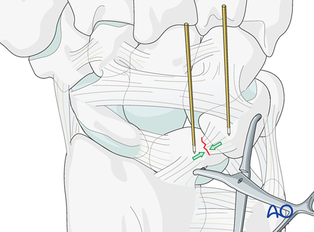 Lunotriquetral ligament rupture - Reducing the lunotriquetral joint with K-wires and reduction forceps