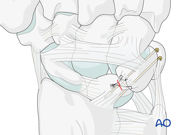 Lunotriquetral ligament repair with a suture anchor and K-wire joint transfixation