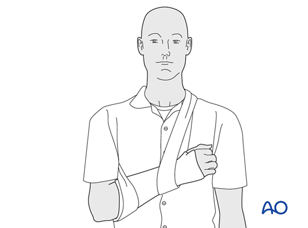 Forearm and wrist in a splint with the arm in a sling