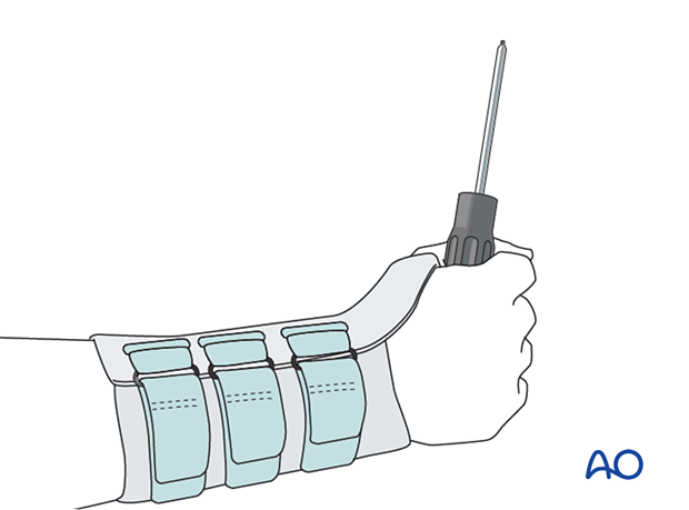 External splintage used to protect the healed limb during ‘at risk’ activities