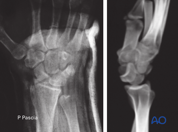 AP and lateral x-rays of a lunate dislocation. In the lateral view, the so-called spilled-teacup sign is clearly visible.