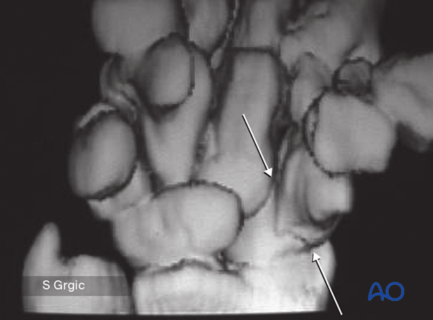 3-D CT rendering shows fracture and its relation to the lunate and capitate in a case of suspected scapholunate fracture-dislocation. The arrows indicate the scaphoid fracture from the ventral aspect.