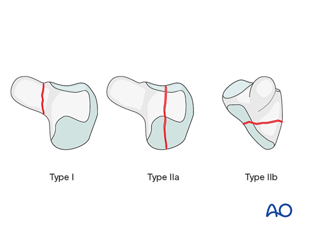 Hirano classification for hamate fractures