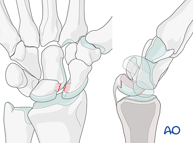 Perilunate injury classification Stage II: lunocapitate dislocation