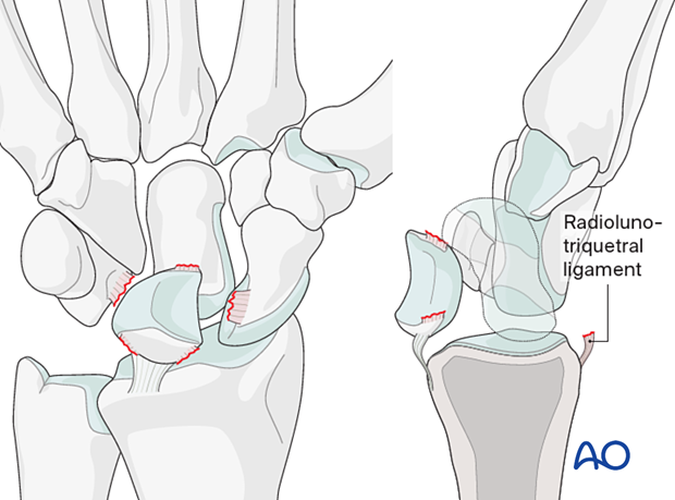 Perilunate injury classification Stage IV: lunate dislocation