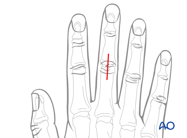 Dorsal approach to the 3rd proximal interphalangeal joint – skin incision