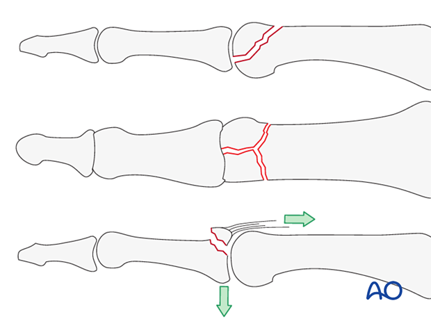 Intraarticular phalangeal fractures - hand