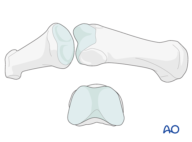 Anatomy of the interphalangeal joint articular surfaces - finger