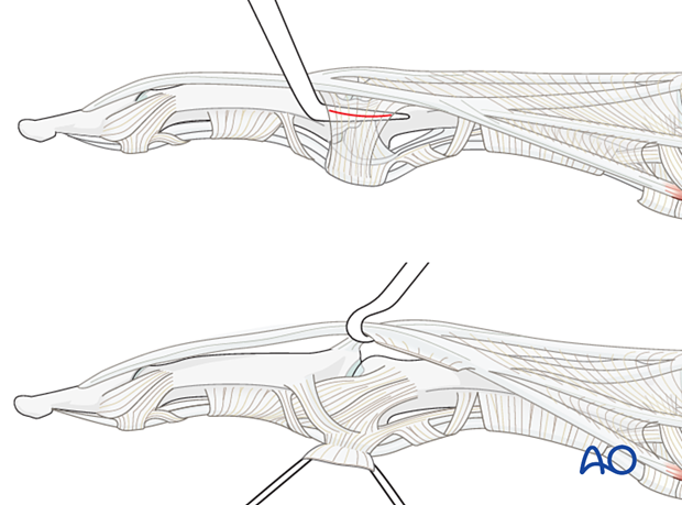 Incision of longitudinal band and division of retinacular ligament with dental pick of the proximal interphalangeal joint