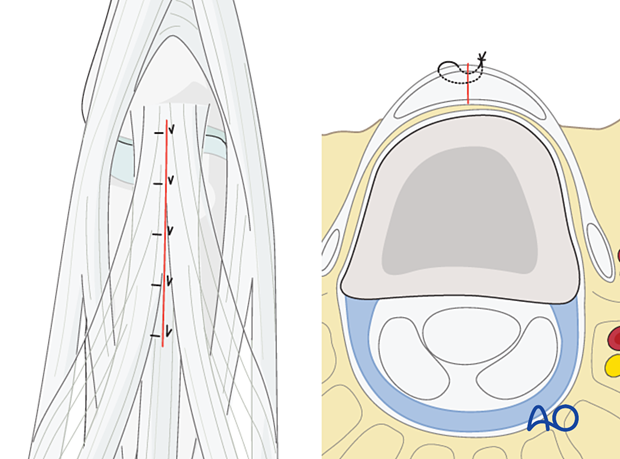 Tendon repair with nonabsorbable monofilament sutures – proximal interphalangeal joint