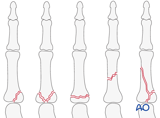 Phalangeal fractures of the hand