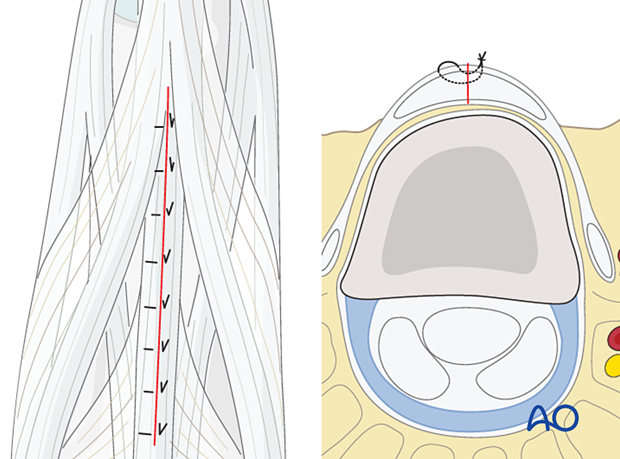 Tendon repair with nonabsorbable monofilament sutures – proximal interphalangeal joint