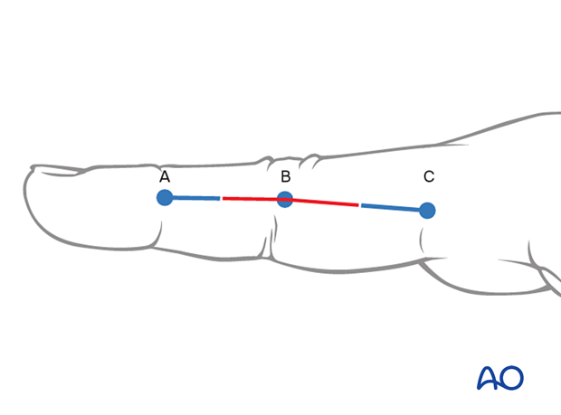 Midaxial approach to the proximal interphalangeal joint