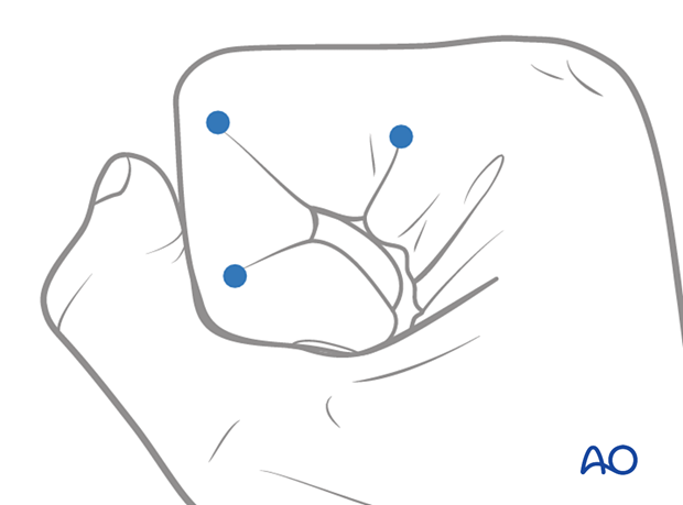 Skin marking to plan for incision – midaxial approach to the proximal interphalangeal joint