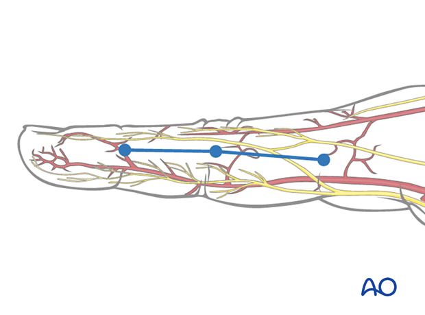 Skin marking indicates line safe for incision with vascular sytem – midaxial approach to the proximal interphalangeal joint