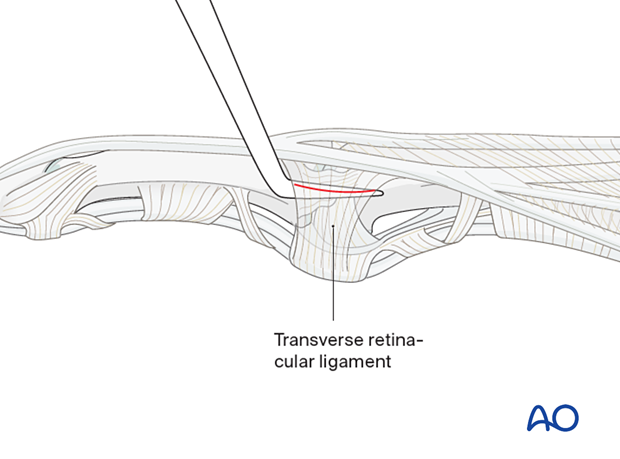 Incision of longitudinal band - proximal interphalangeal joint