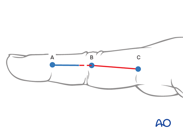 Midaxial (lateral) approach to the proximal phalanx