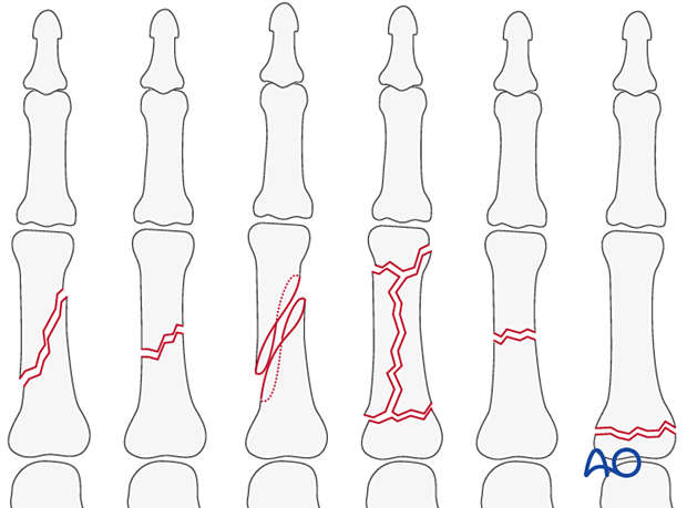 Diaphyseal and metaphyseal phalangeal fractures - hand