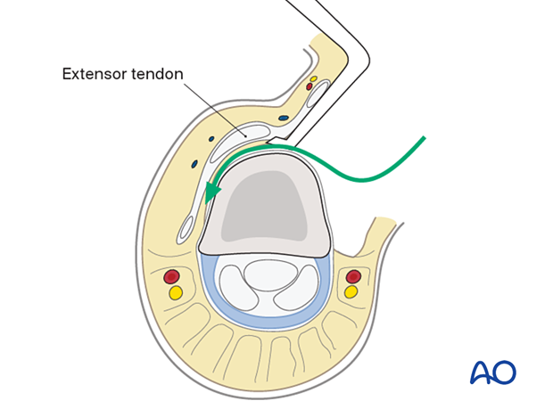 73 A040 Midaxial (lateral) approach to the proximal phalanx