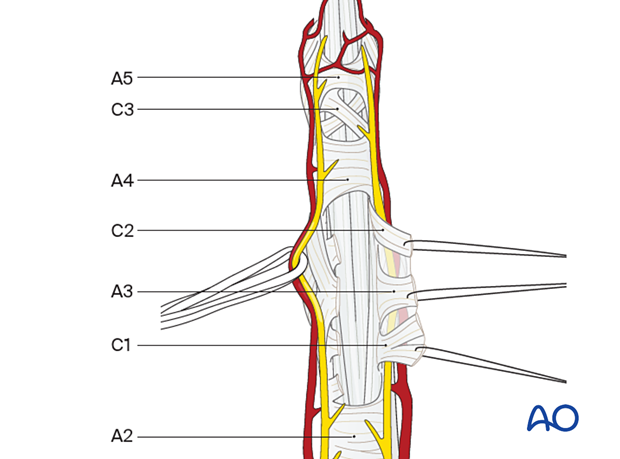 Elevated and sutured C1, A3, and C2 flexor tendon pulleys