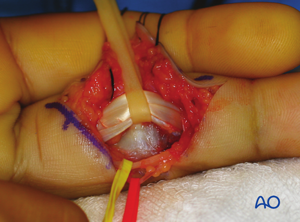 Clinical image of palmar capsule