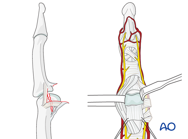 73 A050 Palmar approach to proximal interphalangeal joint