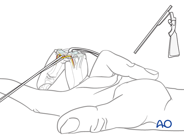 Divided collateral ligaments to allow hyperextension or shotgun exposure 