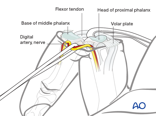 Finger fully hyperextended after collateral ligaments detachment